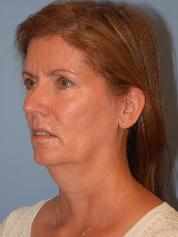 Facelift Before & After Gallery - Patient 92167219 - Image 5