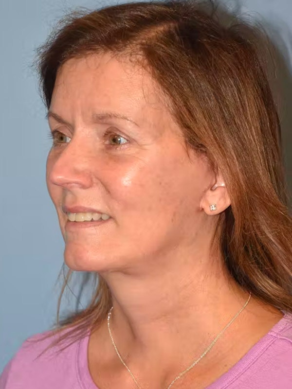 Facelift Before & After Gallery - Patient 92167219 - Image 6
