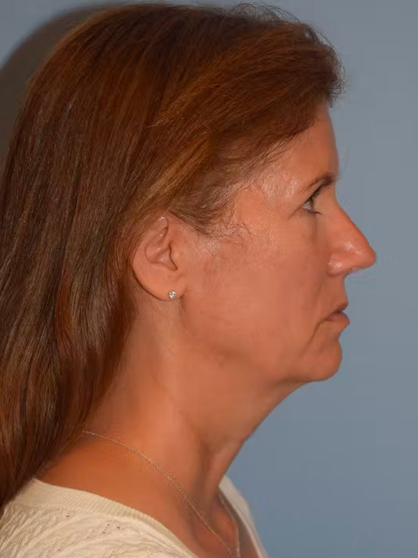 Facelift Before & After Gallery - Patient 92167219 - Image 7