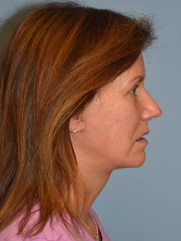 Facelift Before & After Gallery - Patient 92167219 - Image 8