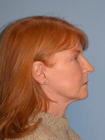 Facelift Before & After Gallery - Patient 96867000 - Image 8