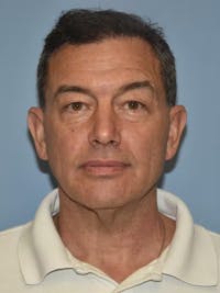 Facelift Before & After Gallery - Patient 96870926 - Image 1