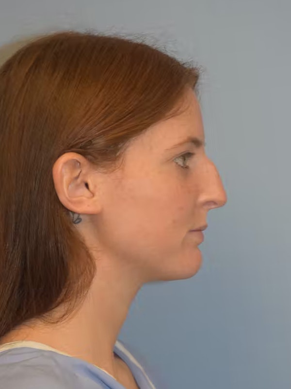 Rhinoplasty Before & After Gallery - Patient 26309192 - Image 1