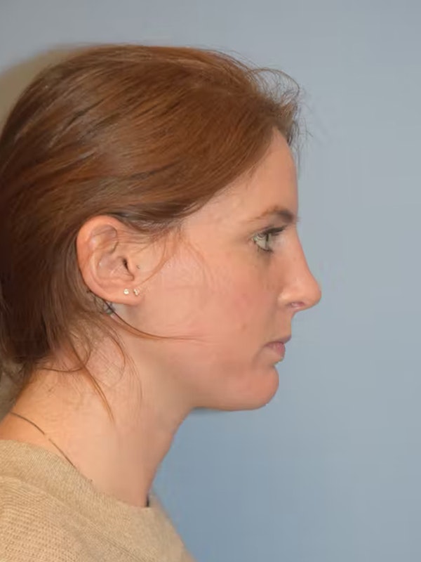 Rhinoplasty Before & After Gallery - Patient 26309192 - Image 2