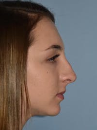 Rhinoplasty Before & After Gallery - Patient 40623592 - Image 1