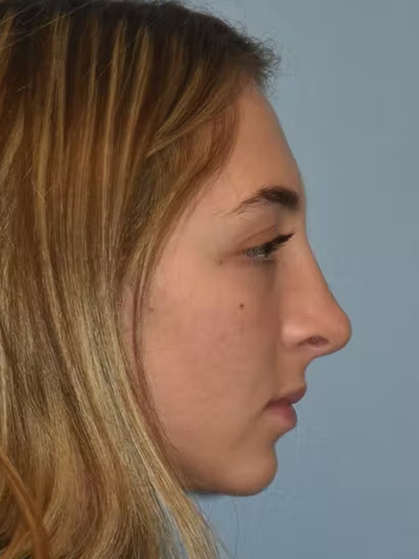 Rhinoplasty Before & After Gallery - Patient 40623592 - Image 2