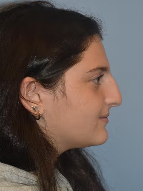 Rhinoplasty Before & After Gallery - Patient 40631898 - Image 1