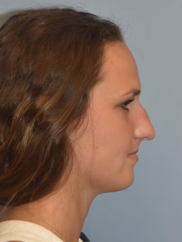Rhinoplasty Before & After Gallery - Patient 40631899 - Image 1