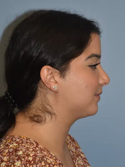Submental Liposuction Before & After Gallery - Patient 96842482 - Image 1