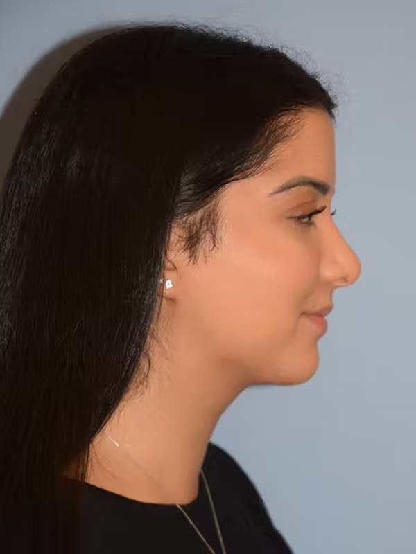 Submental Liposuction Before & After Gallery - Patient 96842482 - Image 2