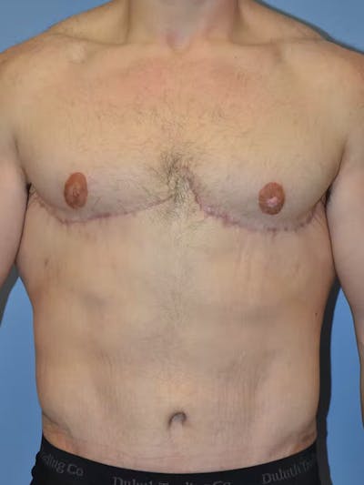 Gynecomastia Before & After Gallery - Patient 96426389 - Image 2