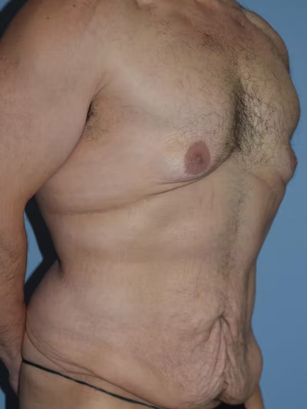 Gynecomastia Before & After Gallery - Patient 96426389 - Image 3