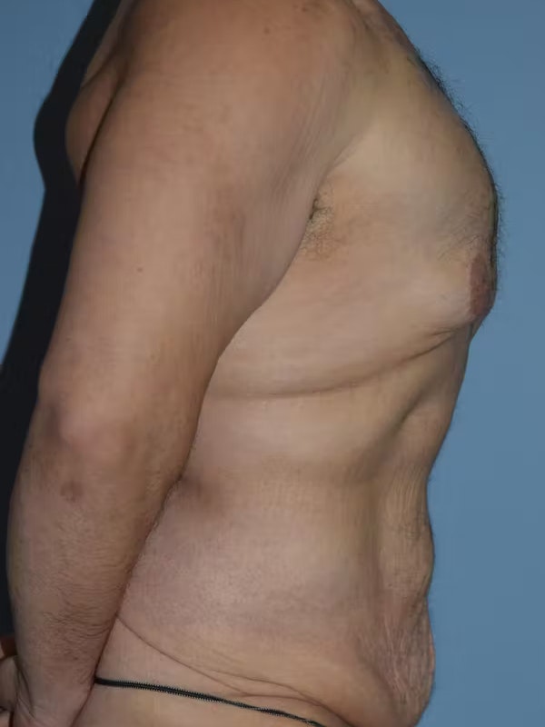 Gynecomastia Before & After Gallery - Patient 96426389 - Image 5