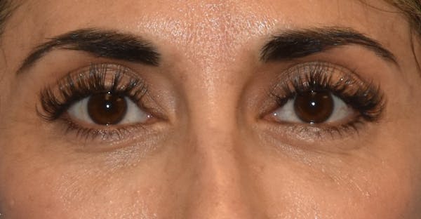 Eyelid Lift Before & After Gallery - Patient 142466513 - Image 2
