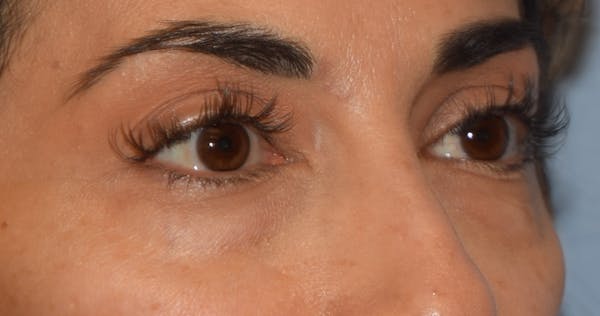 Eyelid Lift Before & After Gallery - Patient 142466513 - Image 3