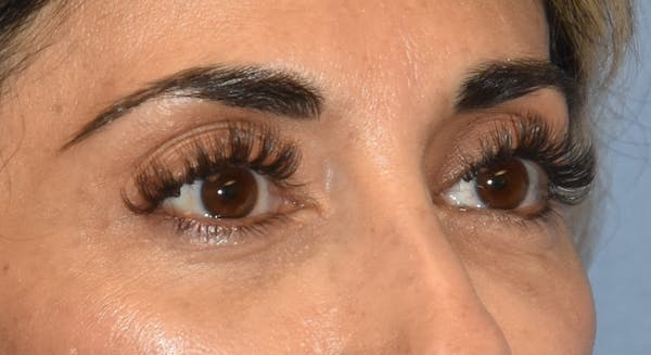 Eyelid Lift Before & After Gallery - Patient 142466513 - Image 4