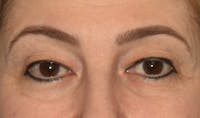 Eyelid Lift Before & After Gallery - Patient 143262744 - Image 1