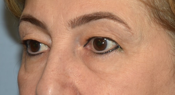 Eyelid Lift Before & After Gallery - Patient 143262744 - Image 3
