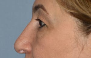 Before and After Blepharoplasty in Long Island