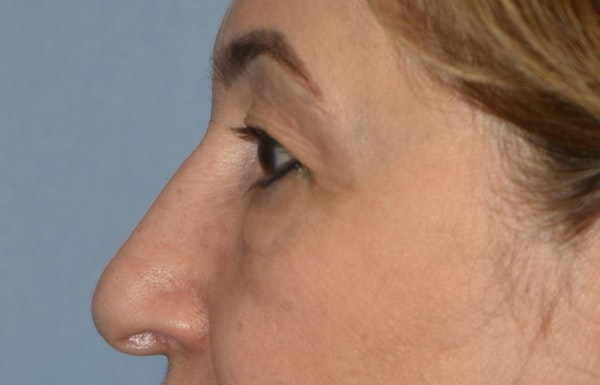 Eyelid Lift Before & After Gallery - Patient 143262744 - Image 5