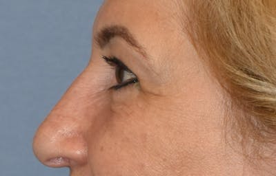 Eyelid Lift Before & After Gallery - Patient 143262744 - Image 6