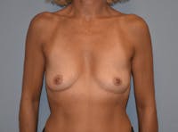 Breast Augmentation Before & After Gallery - Patient 143263771 - Image 1