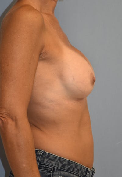 Breast Augmentation Before & After Gallery - Patient 143263771 - Image 6