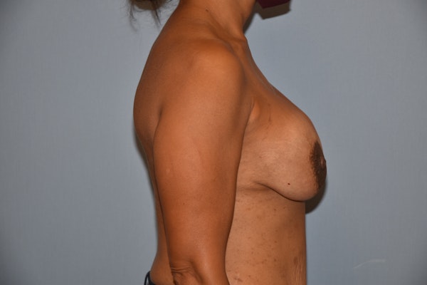 Breast Reduction Before & After Gallery - Patient 145355474 - Image 3