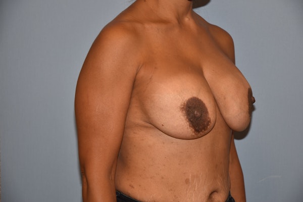 Breast Reduction Before & After Gallery - Patient 145355474 - Image 5