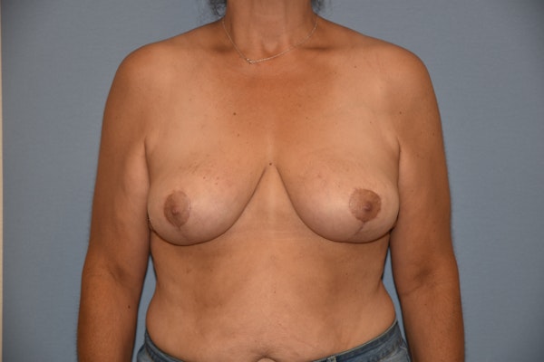 Breast Reduction Before & After Gallery - Patient 145354045 - Image 2