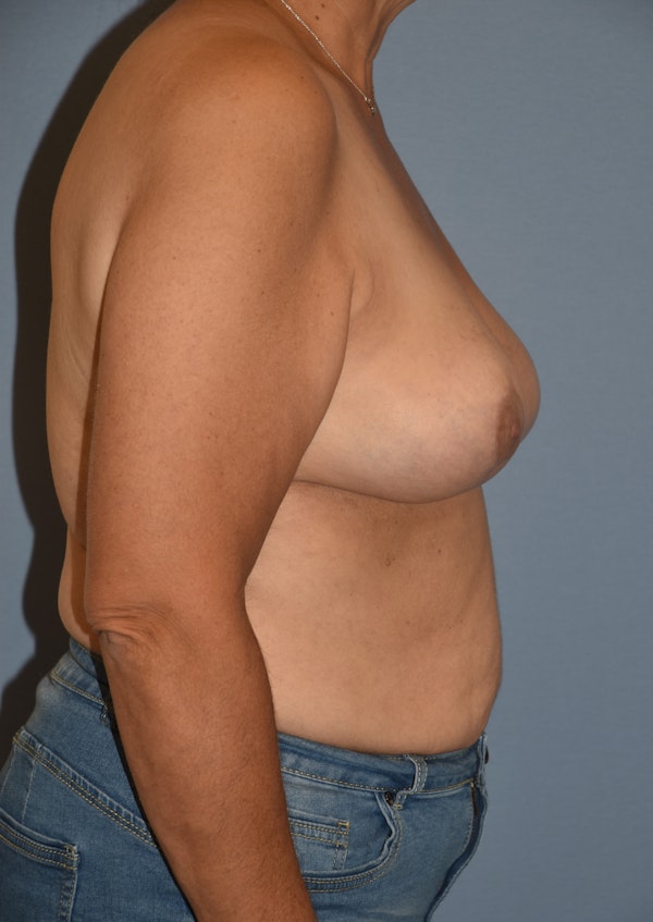 Breast Reduction Before & After Gallery - Patient 145354045 - Image 4