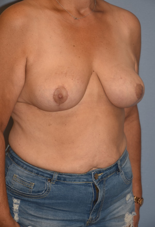 Breast Reduction Before & After Gallery - Patient 145354045 - Image 6