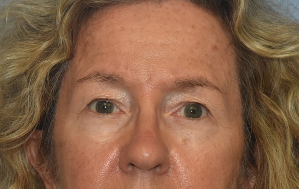 Eyelid Lift Before & After Gallery - Patient 122888312 - Image 1