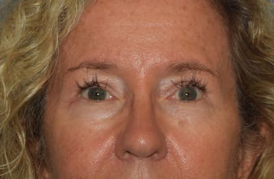 Eyelid Lift Before & After Gallery - Patient 122888312 - Image 2