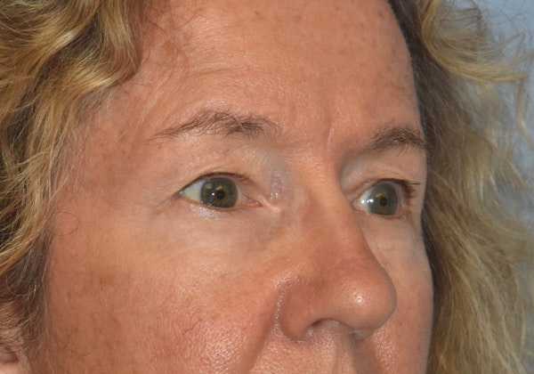 Eyelid Lift Before & After Gallery - Patient 122888312 - Image 3
