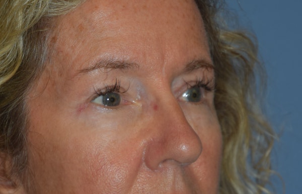 Eyelid Lift Before & After Gallery - Patient 122888312 - Image 4