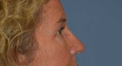 Eyelid Lift Before & After Gallery - Patient 122888312 - Image 6