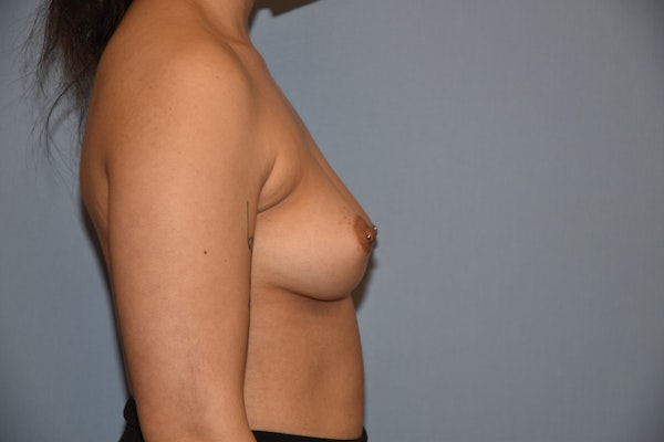 Breast Augmentation  Before & After Gallery - Patient 145355642 - Image 3
