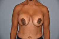 Breast Reduction Before & After Gallery - Patient 145355474 - Image 1