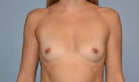 Breast Reduction Before & After Gallery - Patient 145355408 - Image 1
