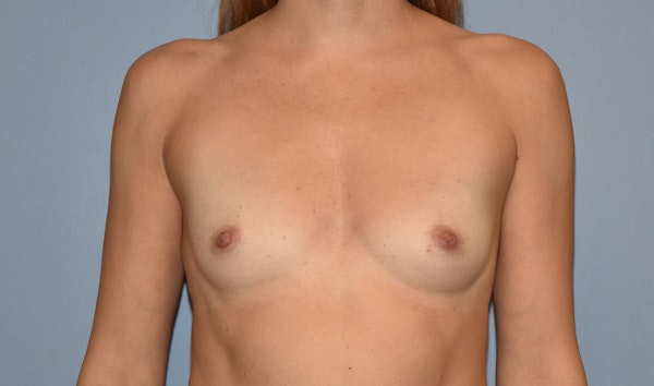 Breast Reduction Before & After Gallery - Patient 145355408 - Image 1