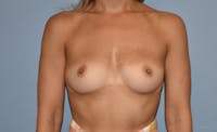 Breast Augmentation Before & After Gallery - Patient 145354205 - Image 1