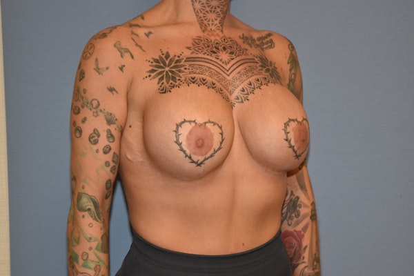 Breast Augmentation  Before & After Gallery - Patient 145104209 - Image 4