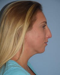 Rhinoplasty Before & After Gallery - Patient 145104053 - Image 1
