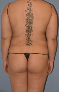 Brazilian Butt Lift Before & After Gallery - Patient 143772975 - Image 1