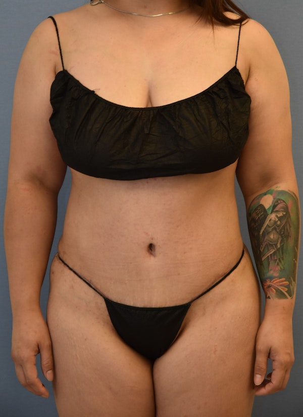 Tummy Tuck Before & After Gallery - Patient 143772936 - Image 2