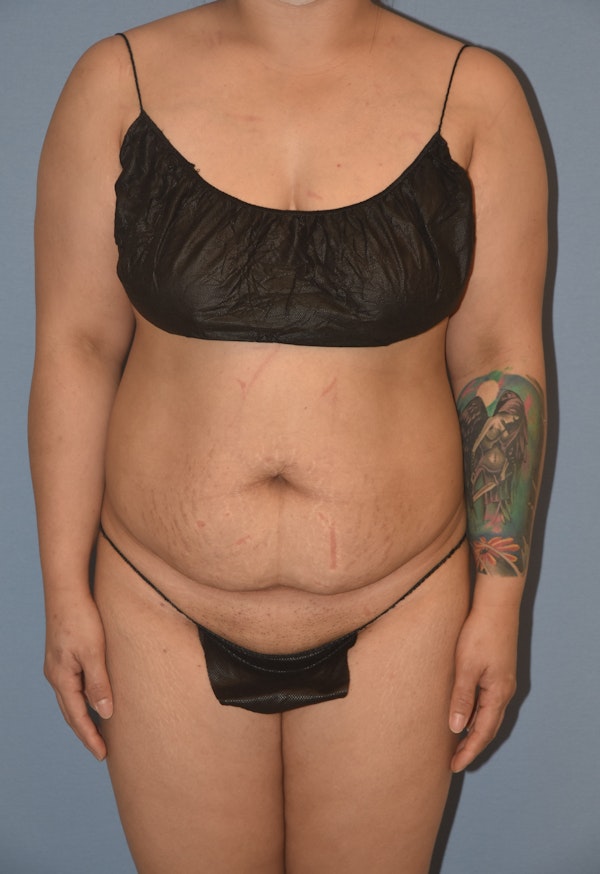 Tummy Tuck Before & After Gallery - Patient 143772936 - Image 1