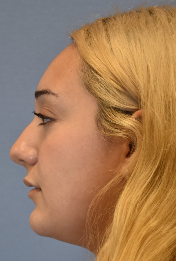 Face Before & After Gallery - Patient 143771436 - Image 3