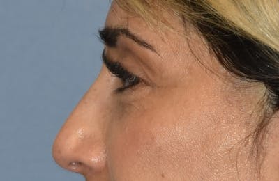 Eyelid Lift Before & After Gallery - Patient 142466513 - Image 6