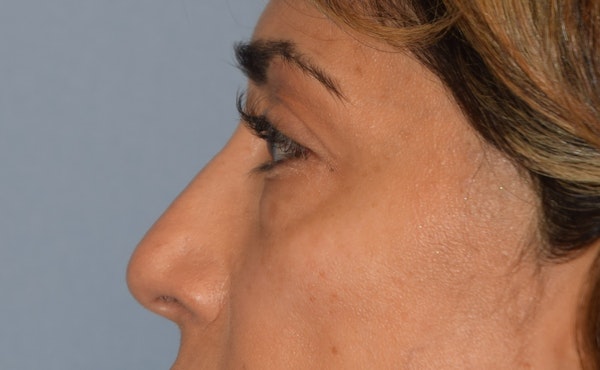 Eyelid Lift Before & After Gallery - Patient 142466513 - Image 5